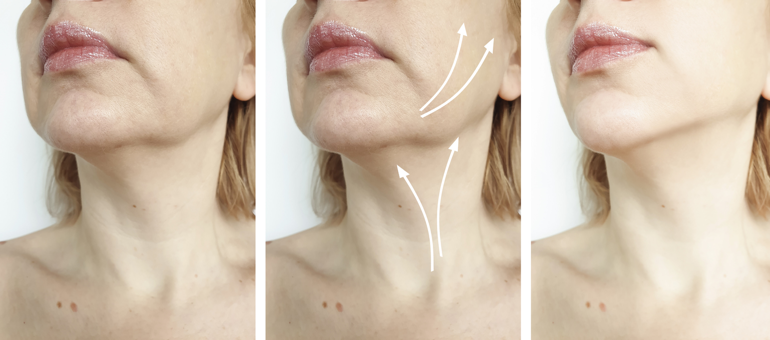 avant après résultats des fils tenseurs sur visage de femme